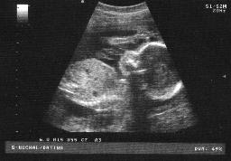 ultrasound scan at 22 weeks