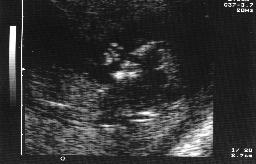 ultrasound scan at 12 weeks